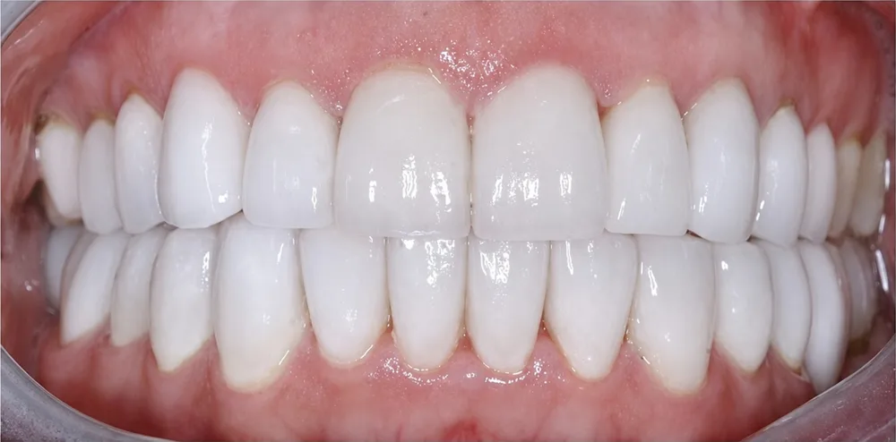 After: Full mouth rehabilitation