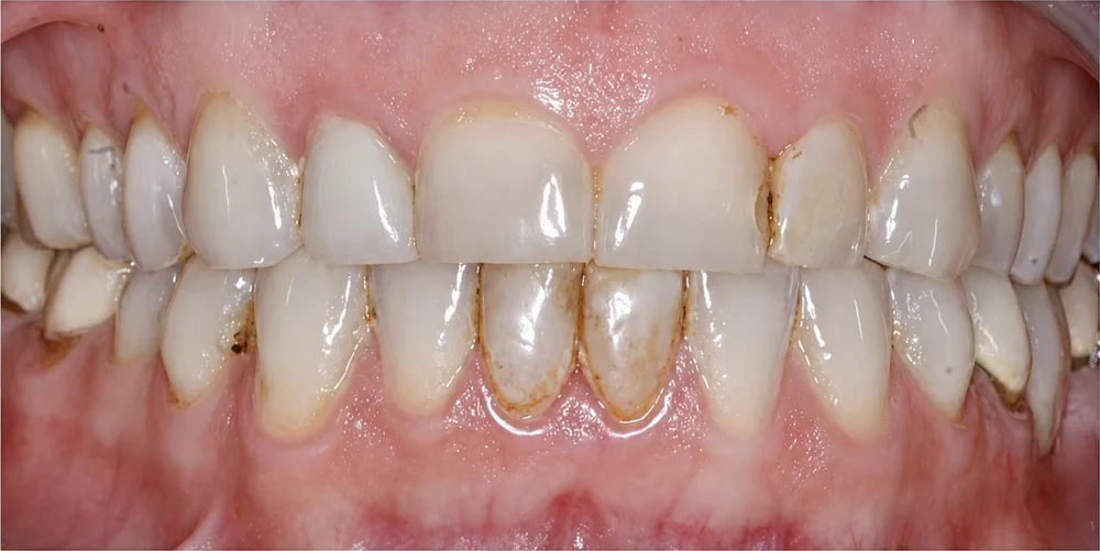 Before: Full mouth rehabilitation