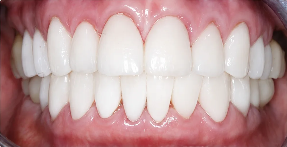 After: Full mouth rehabilitation