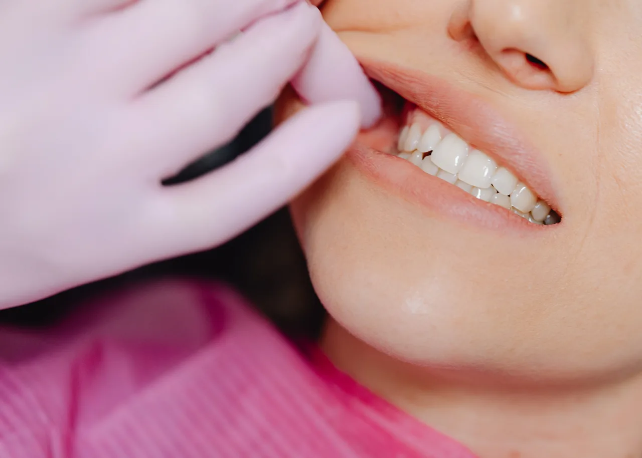 Dental Bonding at Perfect White Smile