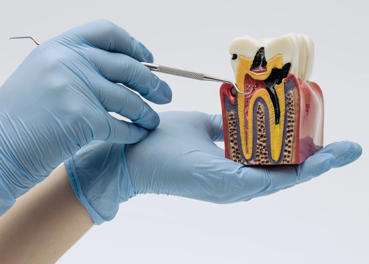 Root Canal at Perfect White Smile