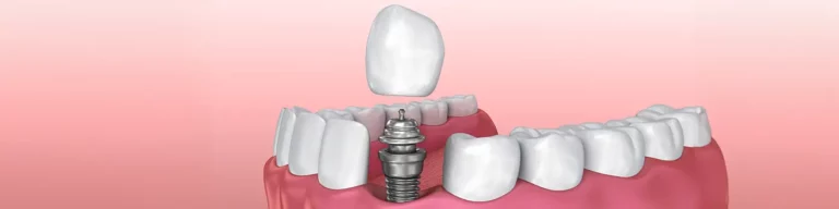 How Is A Crown Attached To A Dental Implant