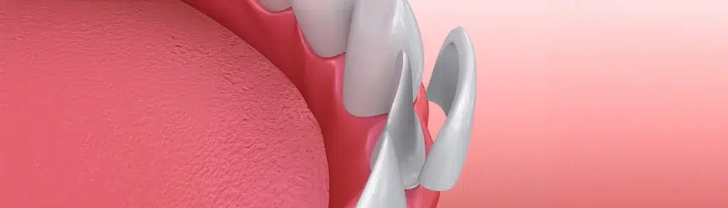 How Long Do Veneers Last