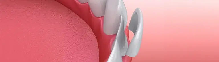 How Long Do Veneers Last