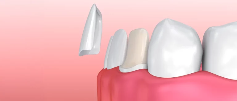 Are Veneers Permanent