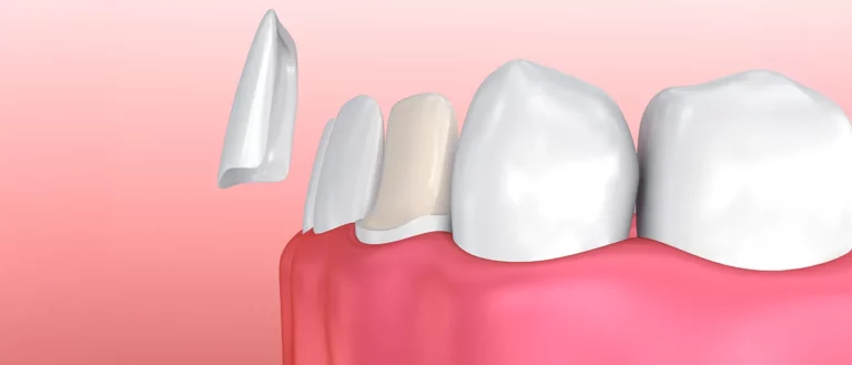 Composite vs Porcelain Veneers