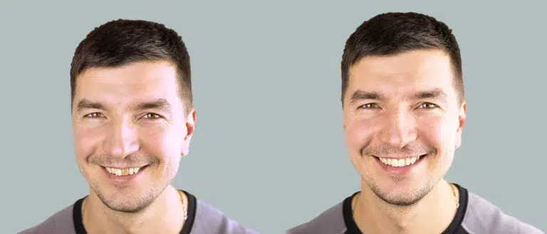 Tooth Restoration vs Tooth Replacement