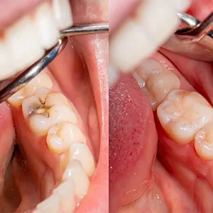 Porcelain Fillings