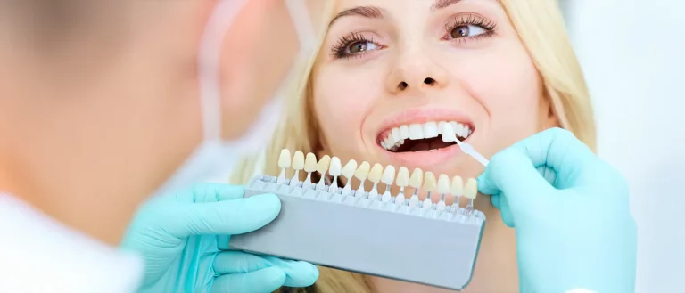 Do Veneers Stay White? The Truth About Long-Lasting Bright Smiles