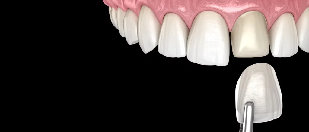Introduction: What Happens to Teeth Under Veneers?