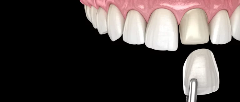 Introduction: What Happens to Teeth Under Veneers?