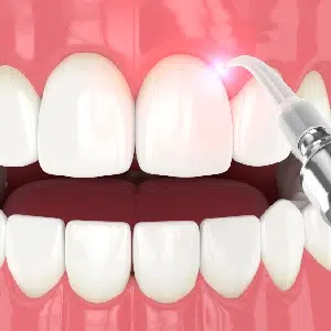 Laser Dentistry vs. Traditional Methods