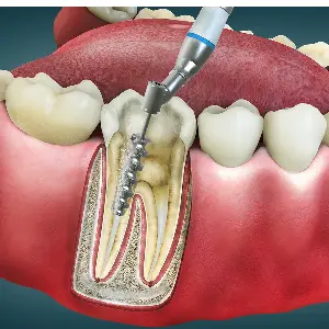 Root Canal